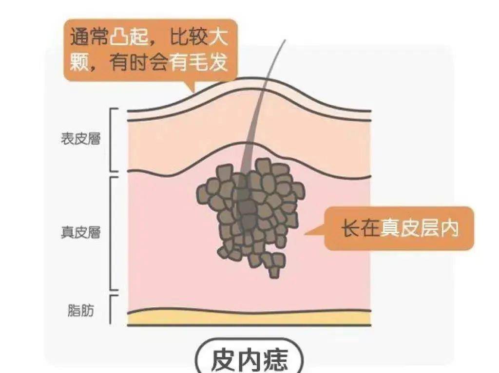 這種痣多為皮內痣,長在真皮內,呈靜止狀態.