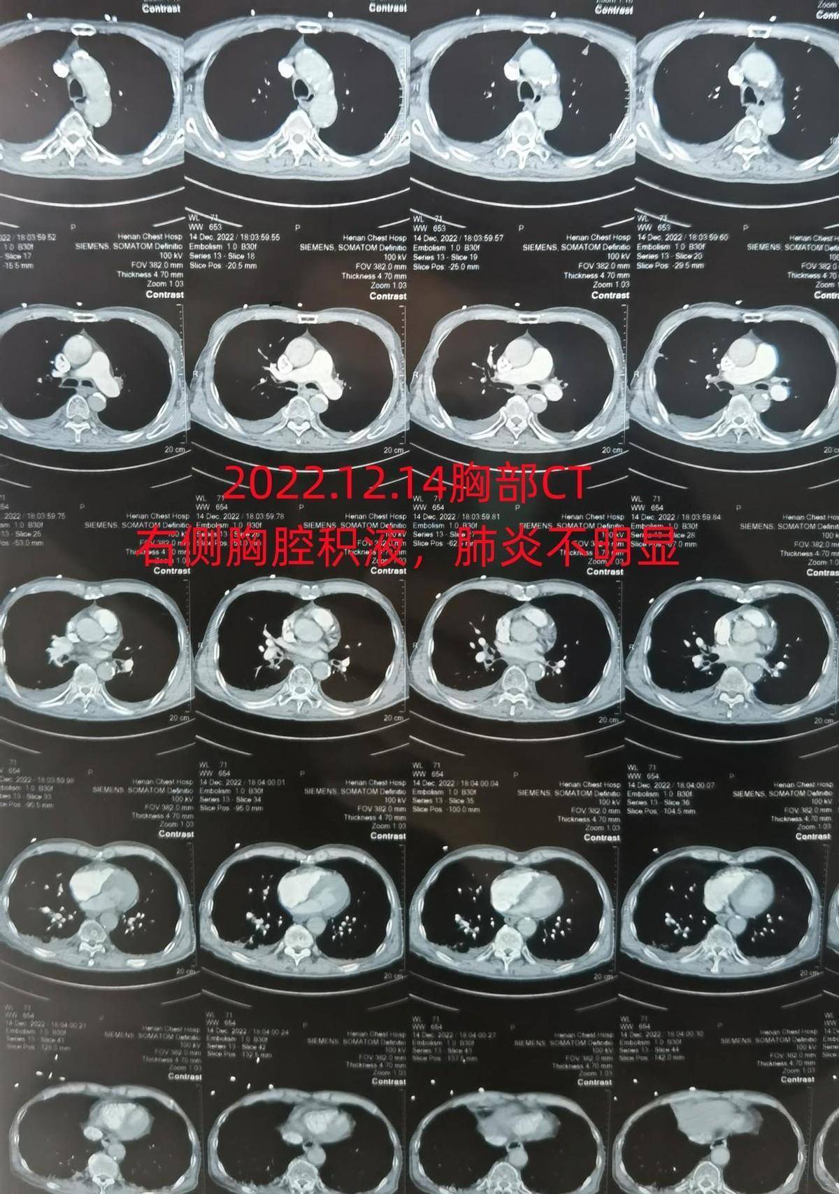 肺炎ct报告单图片图片