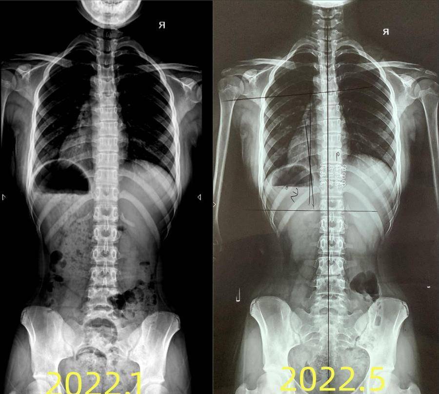 13岁女孩脊柱侧弯26°,努力治疗半年后,成功脱掉支具!