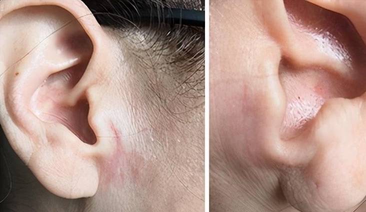 手术早就被淘汰了,很容易造成皮肤张力过大,切口过度增生代偿,疤痕又