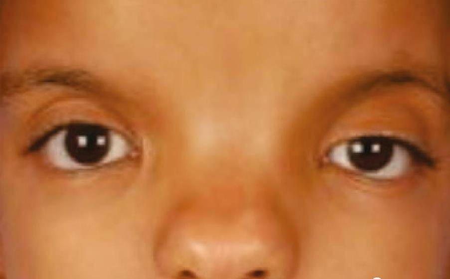 xyy综合征-一种很"男人"的病_染色体_时尚_精子