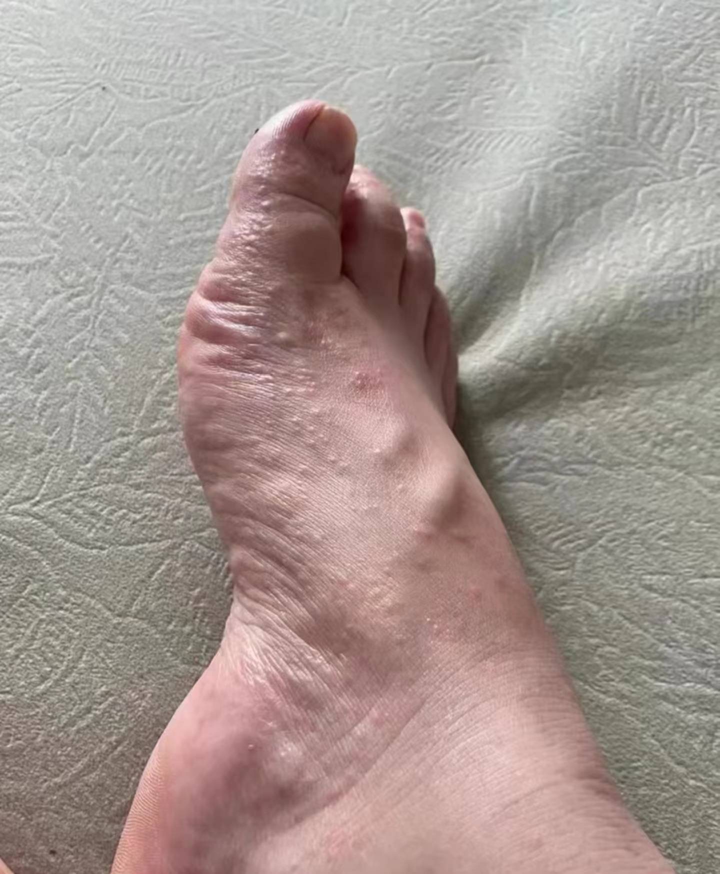 偏方,口服,外用,泡脚等方法我都试了个遍,慢慢的积累出了除脚气经验