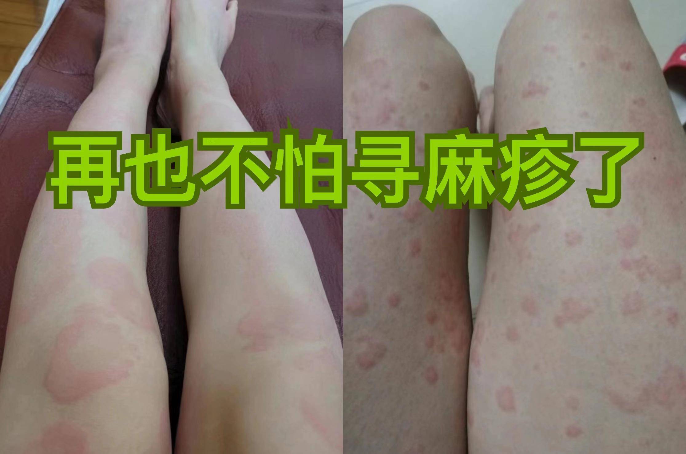 专家分享荨麻疹最佳护理方法!做好下面这3步,想不好都难!_效果_时候_