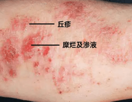 长沙皮肤病专科医院:皮炎和湿疹的区别在哪里?