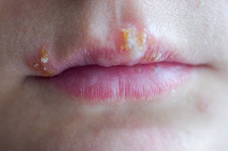 1型单纯性疱疹病毒主要会诱发口周疱疹,一般会在唇边先出现红色丘疹
