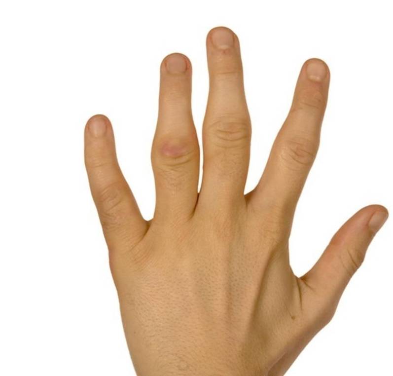 手指肿,关节疼,是关节炎还是痛风?