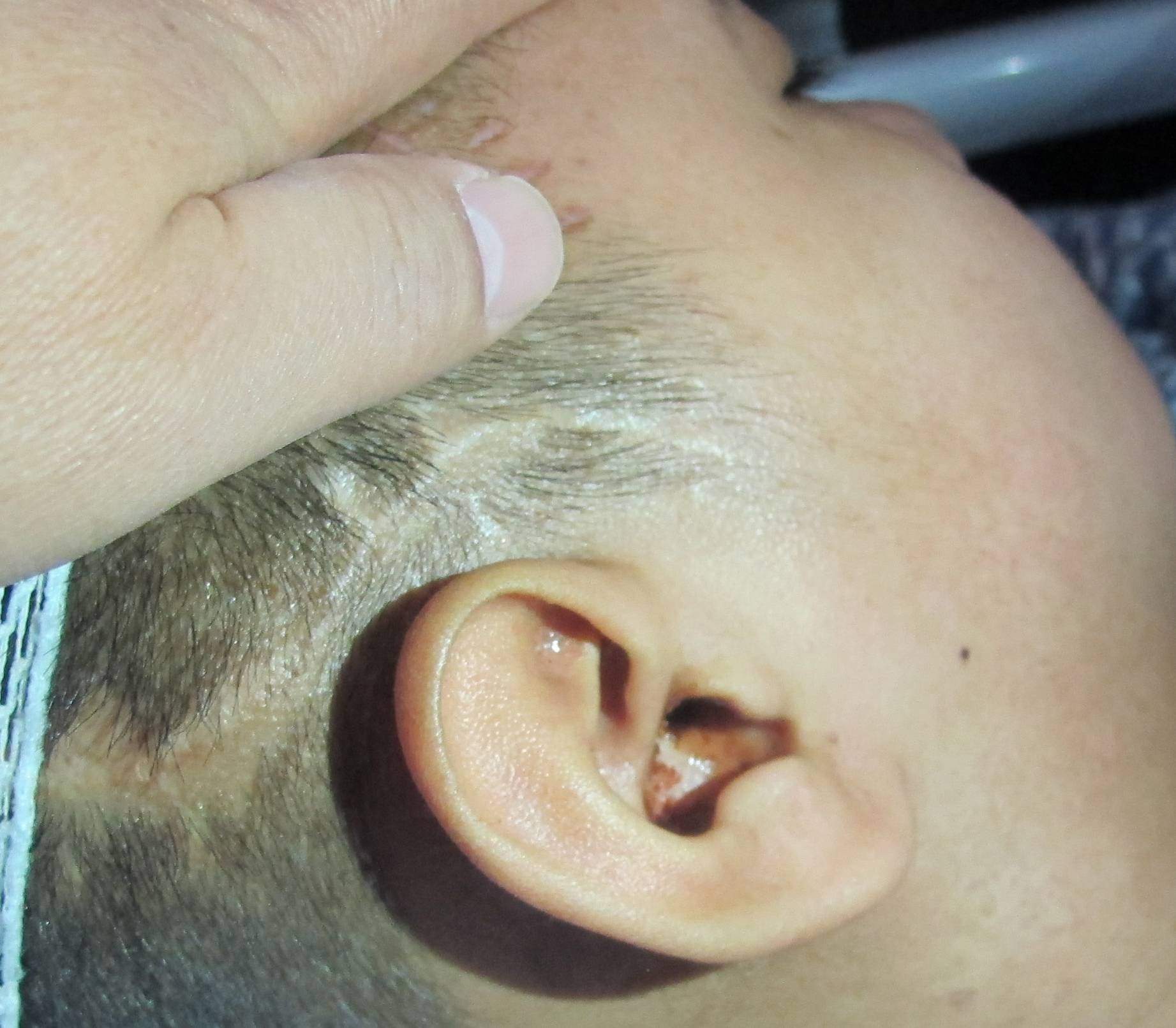 脑外伤术后偏瘫和脑脊液鼻和耳漏,腰大池引流又致难治性颅内感染_治疗