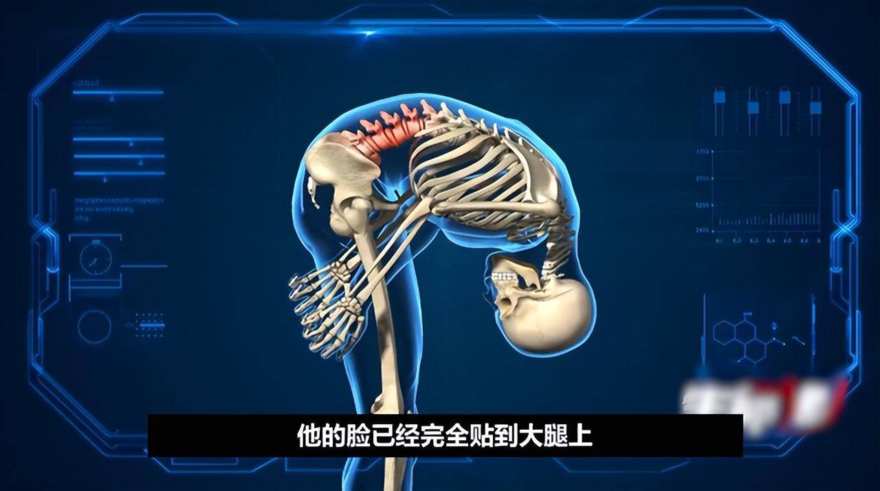 "被折叠的人"李华:骨头敲断4次,植入22颗钢钉,时隔26年获得新生