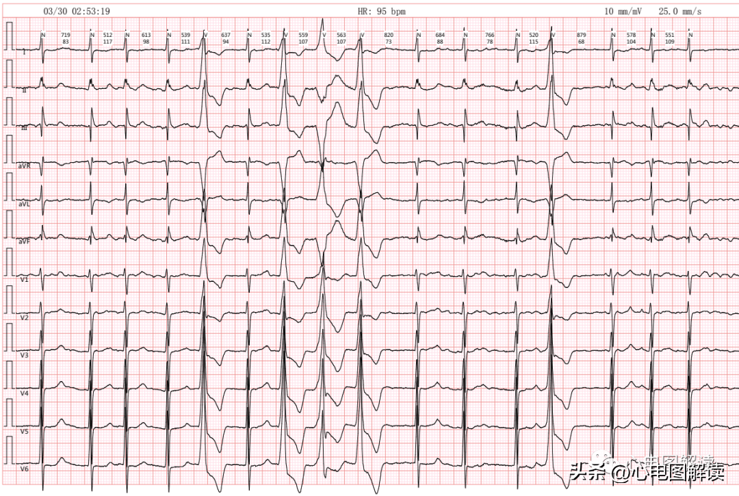 室性扑动心电图图片