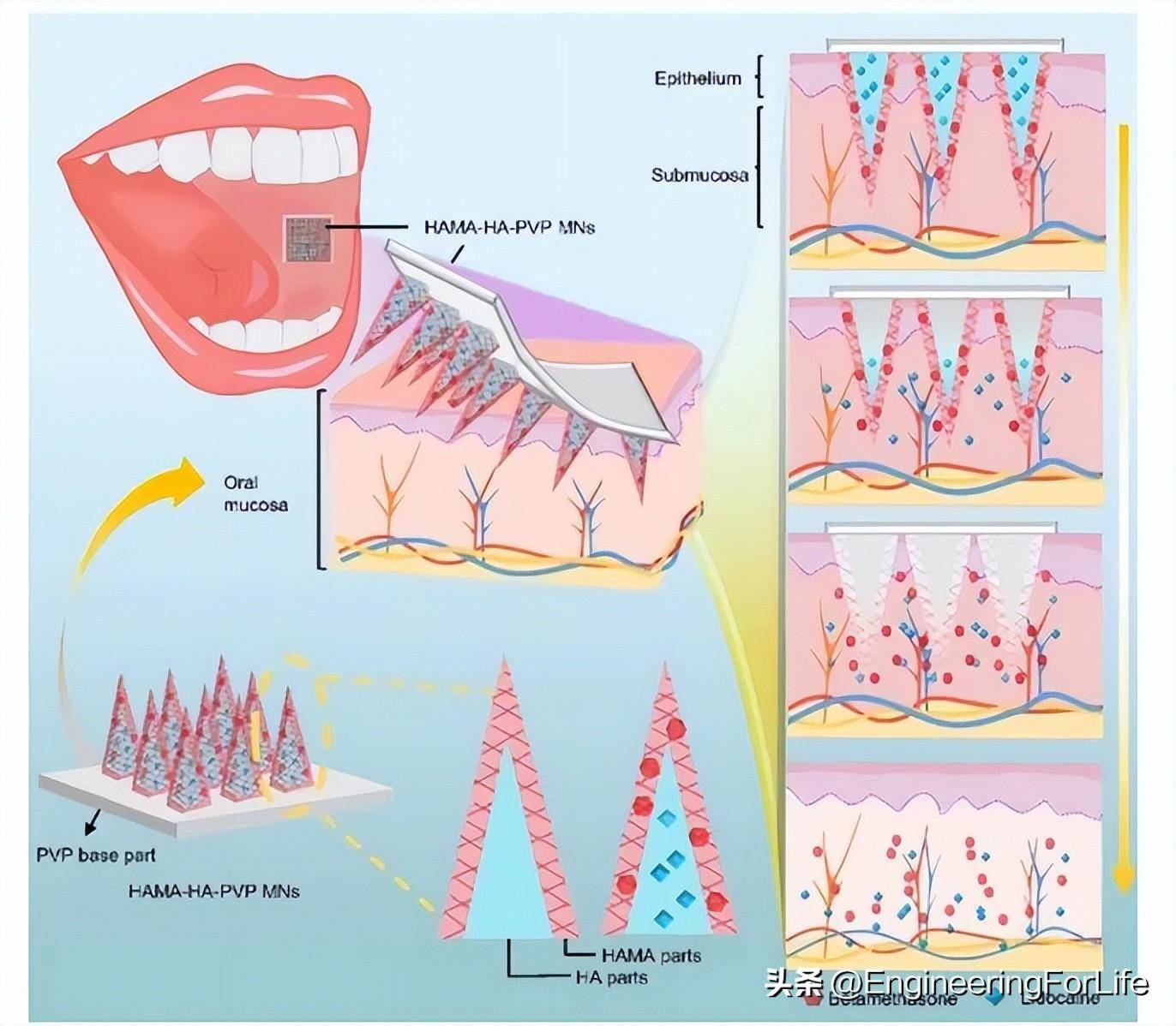 新型双层微针控制给药顺序用于口腔粘膜疾病_黏膜_药物_研究