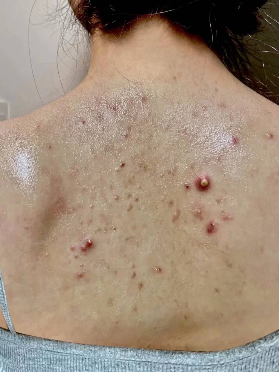 这个居家祛痘法真的牛!后背越洗越光滑!_皮肤_痘痘_基本