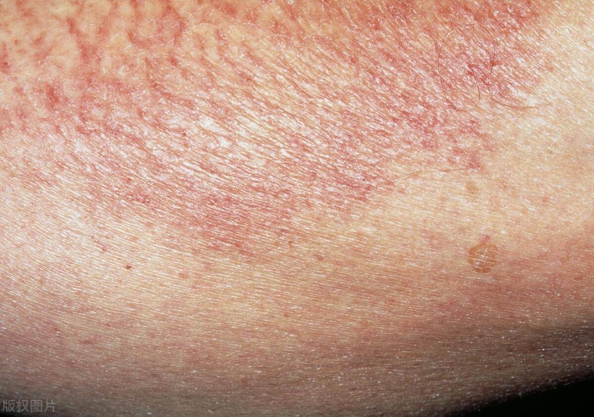 肛门周边皮肤增生图片图片