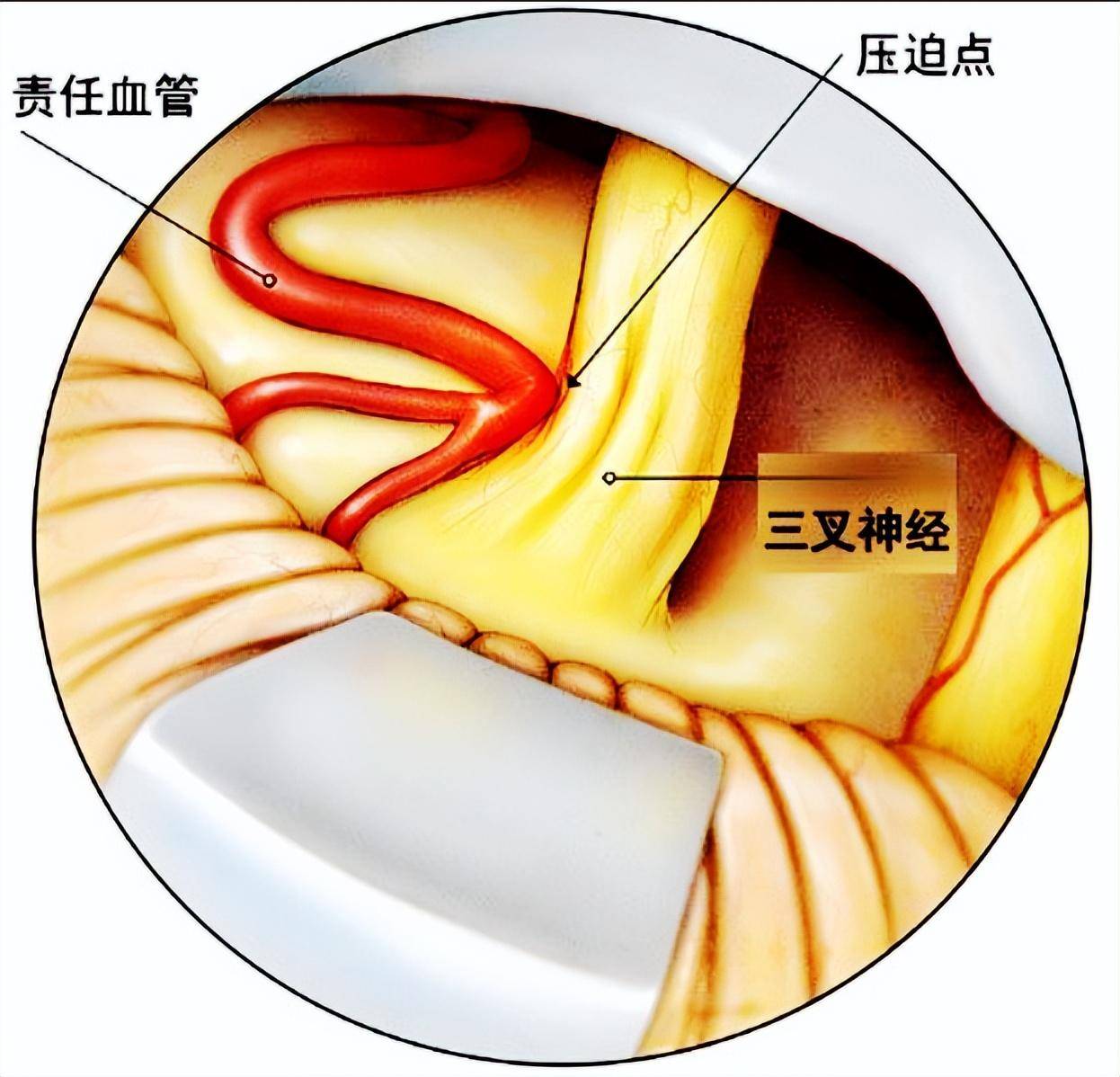 手术是根治三叉神经痛的唯一选择!_治疗_患者_血管