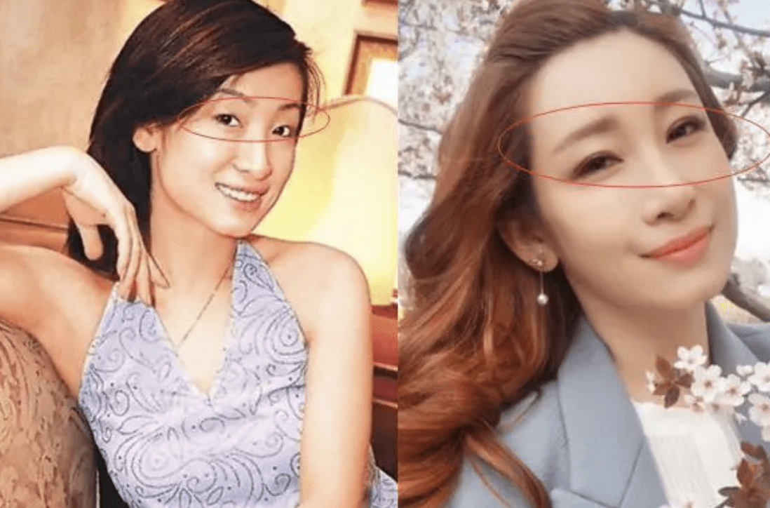 在新剧被吐槽医美过度,脑门整得像寿星公_观众_因为_演技