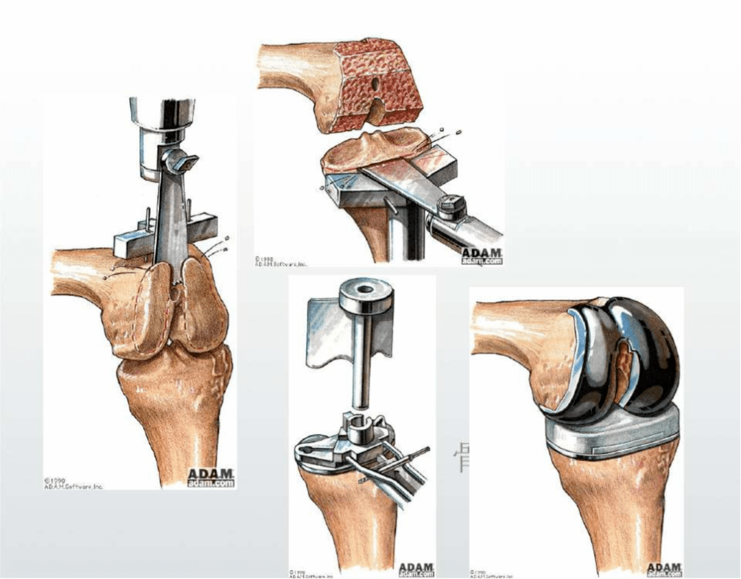 宝鸡市凤翔区医院2022年度获奖新技术新项目展示_膝关节_置换术_手术