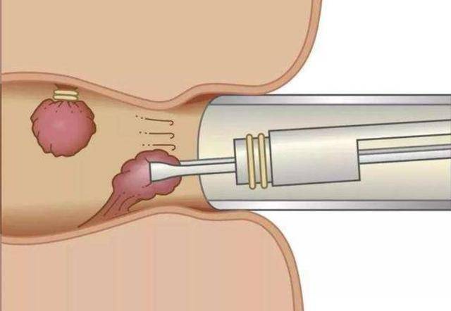 超声引导下痔动脉结扎术采用特制的直肠镜缝合结扎痔疮上方动脉,阻断