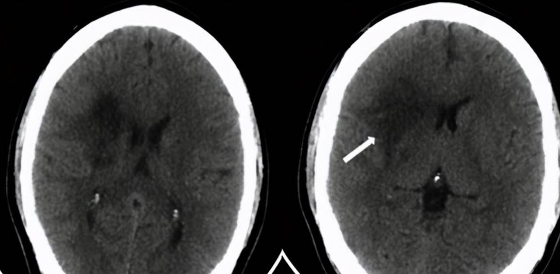 诱因不止有高血压这一个_动脉_血管_栓子