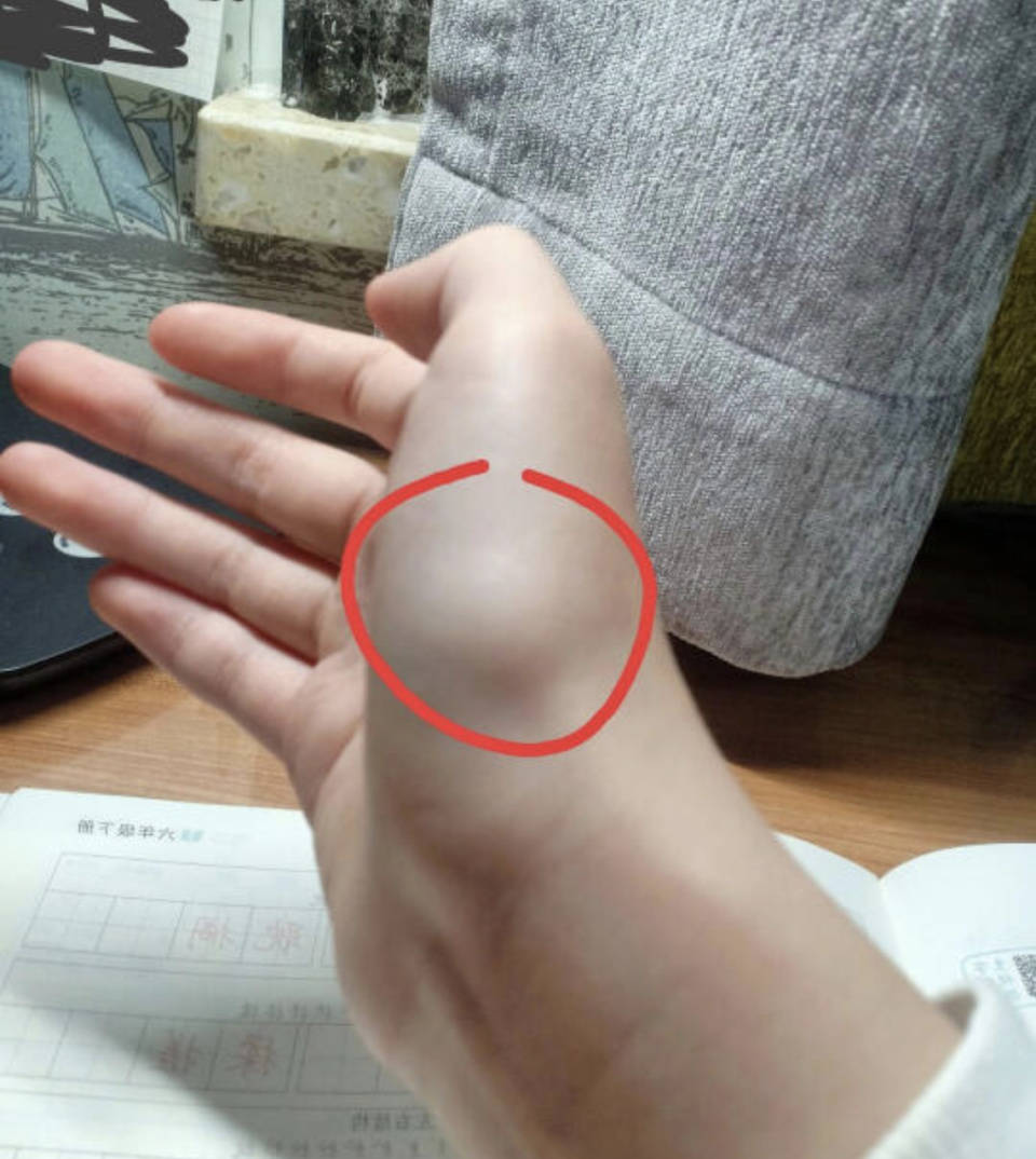 在家解决腱鞘炎,这个经验掌握后能省好几千!_手腕_因为_基本