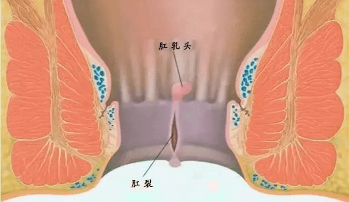肛乳头是在人体齿状线附近的2~6个细小的三角形突起,呈黄白色,高仅1~2