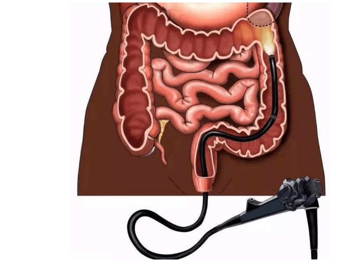 探索腸息肉秘密武器——腸鏡的自我介紹(上)|仁濟醫院消化內科_麻醉