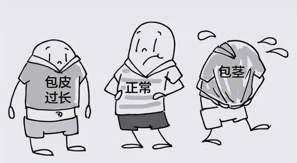 一,管状包茎,阴茎完全被包皮包住,龟头无法从包皮中露出.