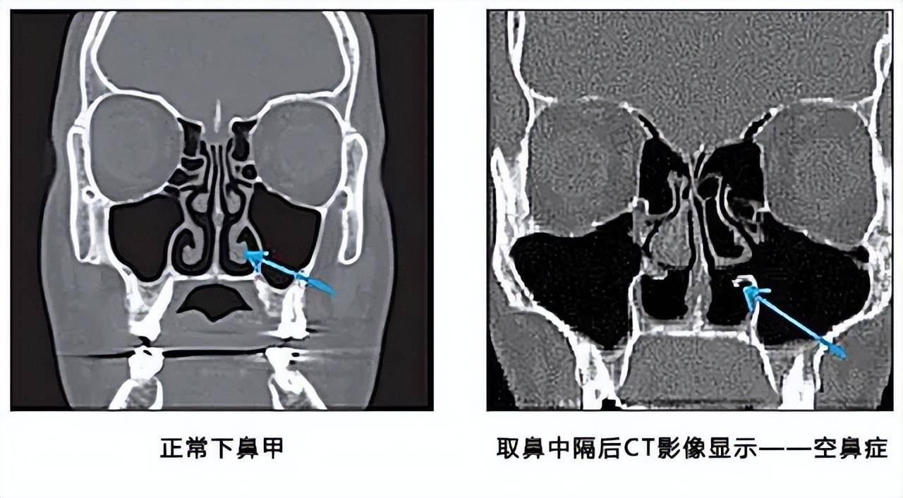 鼻中隔隆鼻的后遗症你都知道哪些!_整形_手术_软骨