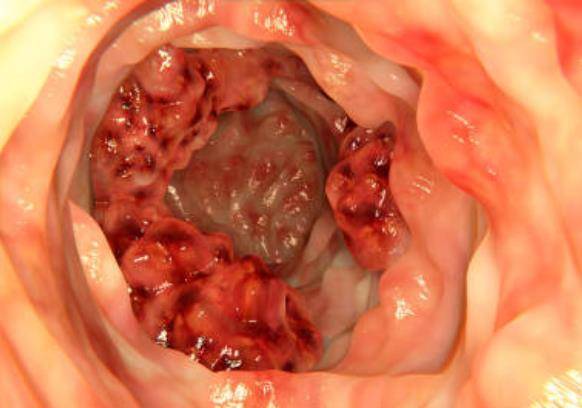 24岁小伙一天大便三次,确定肠病!4种大便异常或是身体"警报"