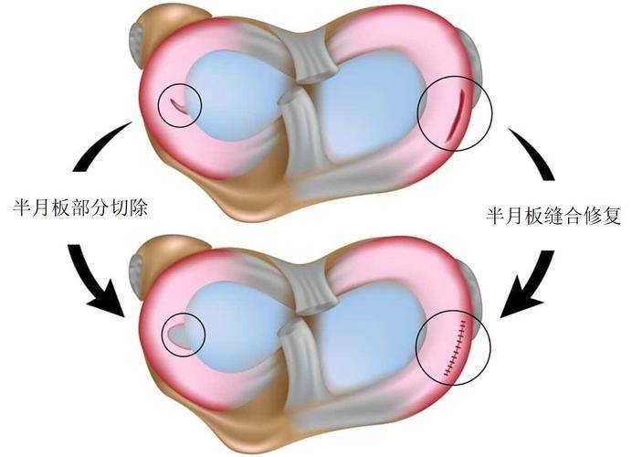 重新认识膝关节半月板撕裂