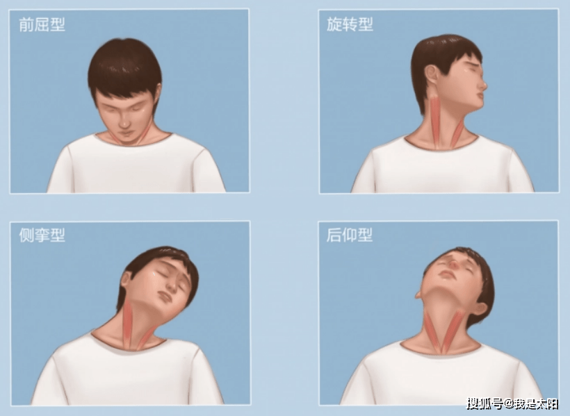 痉挛性斜颈的影响危害_症状_患者_病人