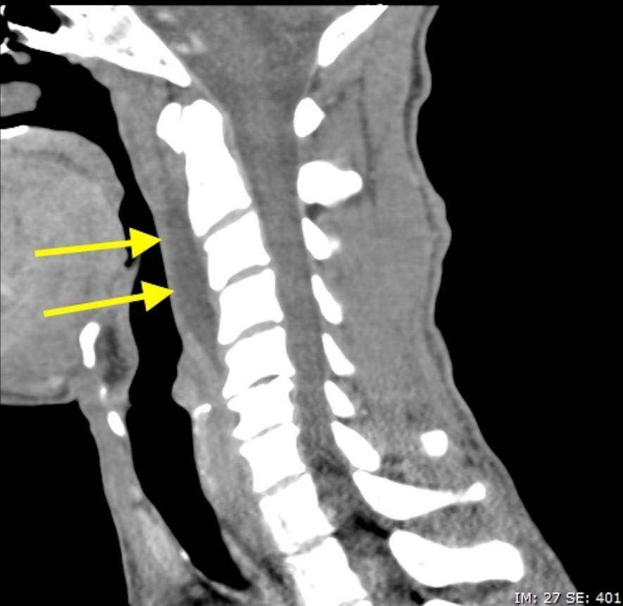 颈椎项韧带钙化图片