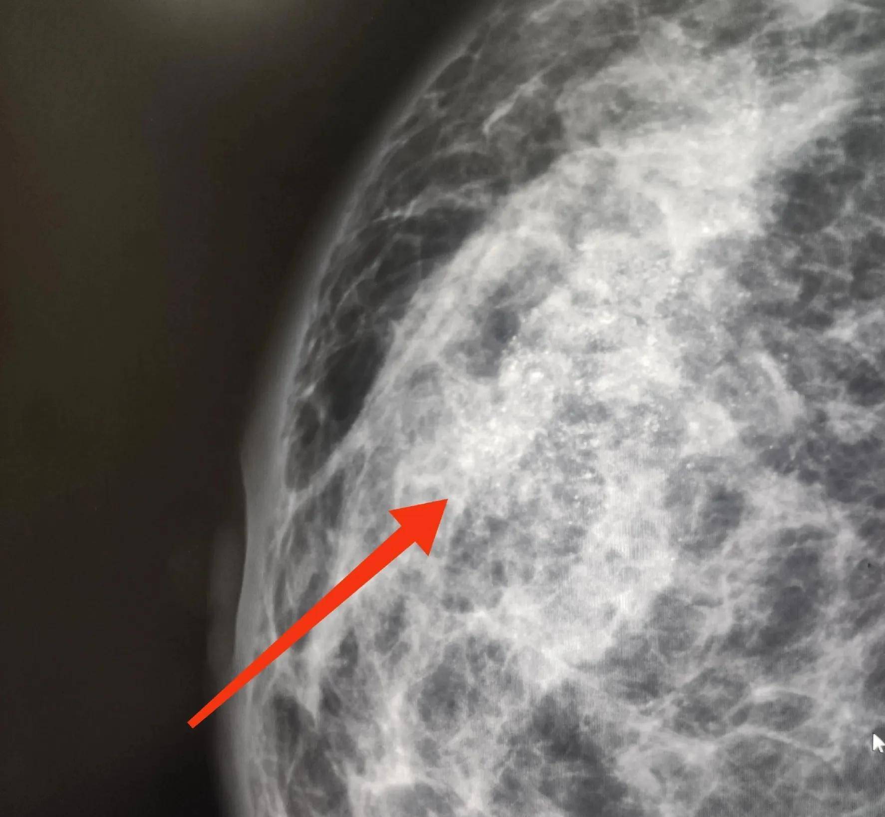 乳腺癌胸壁复发57例图片