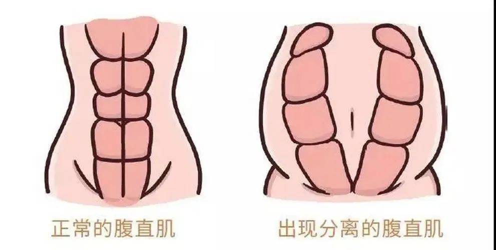 在孕晚期,增大的子宫会将腹肌拉长,使两条腹直肌从腹白线的位置分开