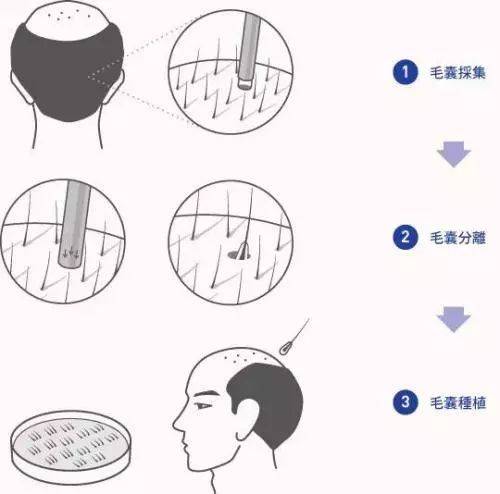 3d植发后怎么洗发(3d植发后怎么洗发好)
