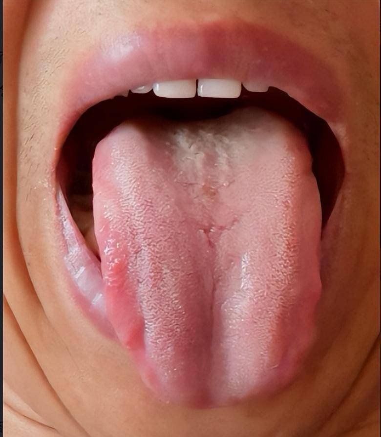 阴虚舌苔图片脾胃湿热图片