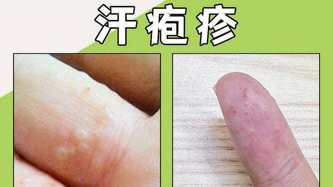 汗疱疹有什么好的治疗办法吗?_症状_影响_生活