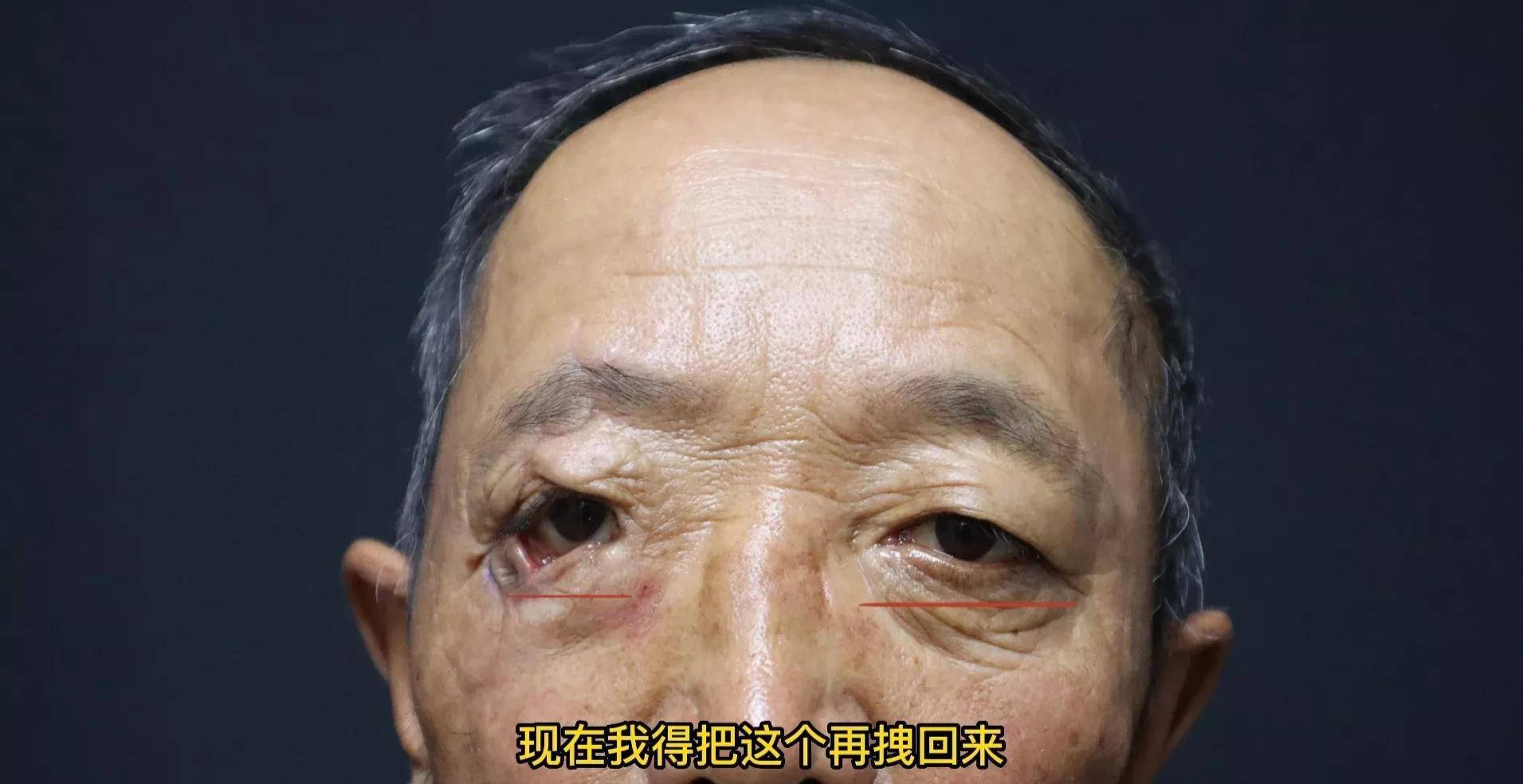 65岁大爷车祸眼睛少了一块闭不上,流泪畏光干痒,术后即刻闭上了_郑
