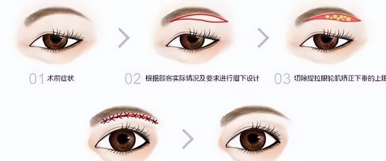 年轻秘诀术：提眉术后1-7天恢复图？提眉术后15天的照片惊呆小伙伴？（提眉手术恢复）