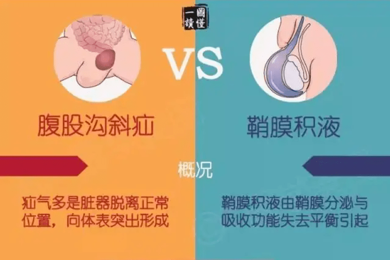 鞘膜积液和疝气是怎么造成的(附区别是什么)