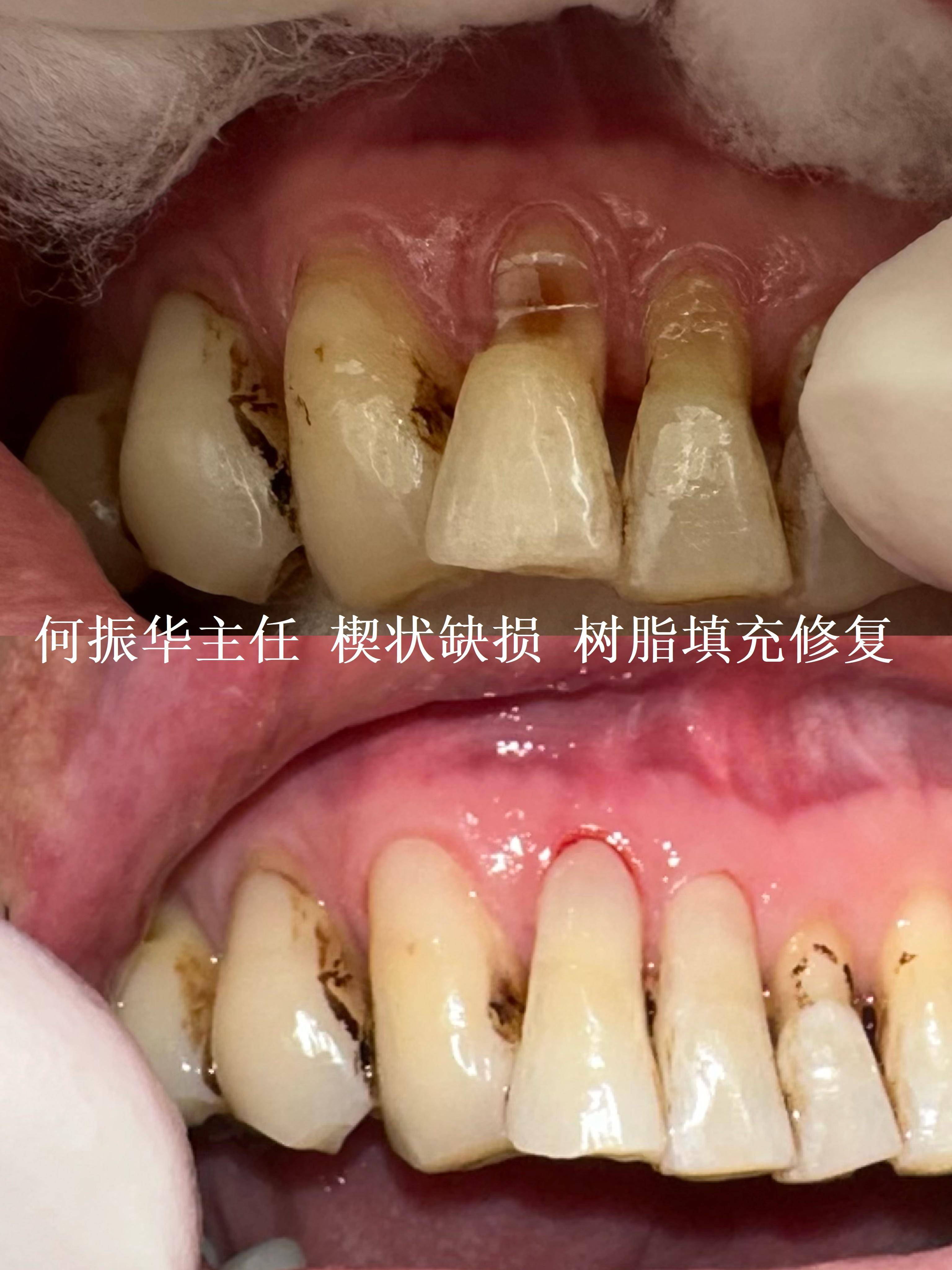 牙齿楔状缺损怎么治疗图片