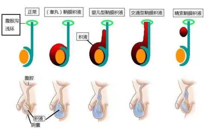 鞘膜积液和疝气是怎么造成的(附区别是什么)