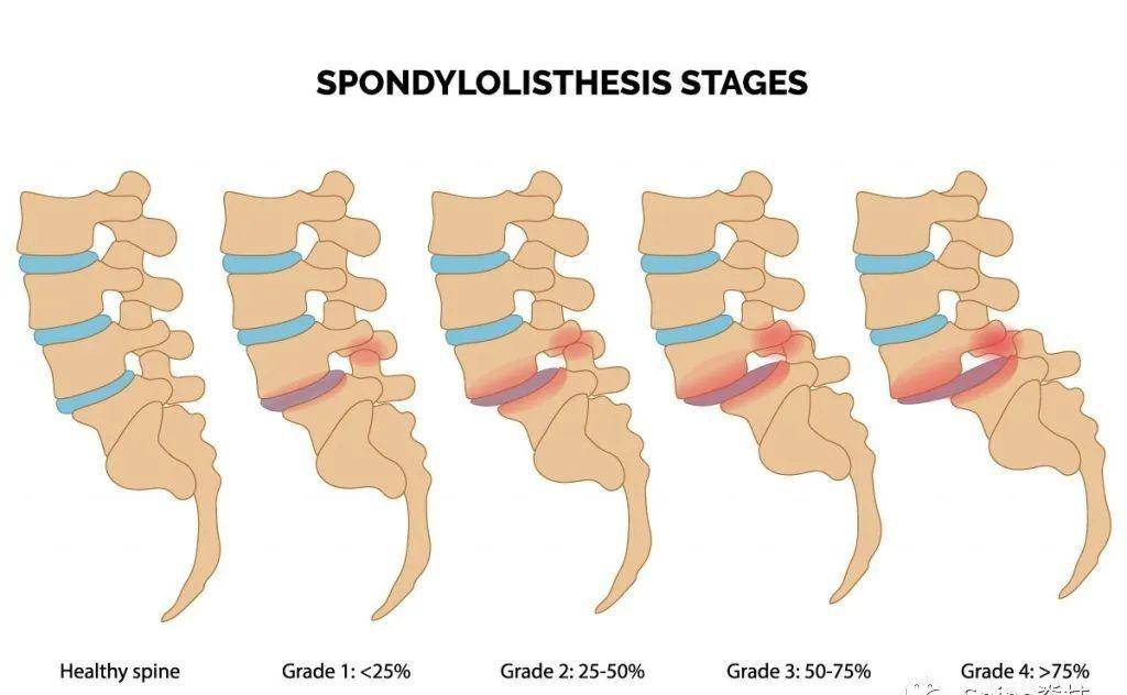 腰椎滑脱分级图片