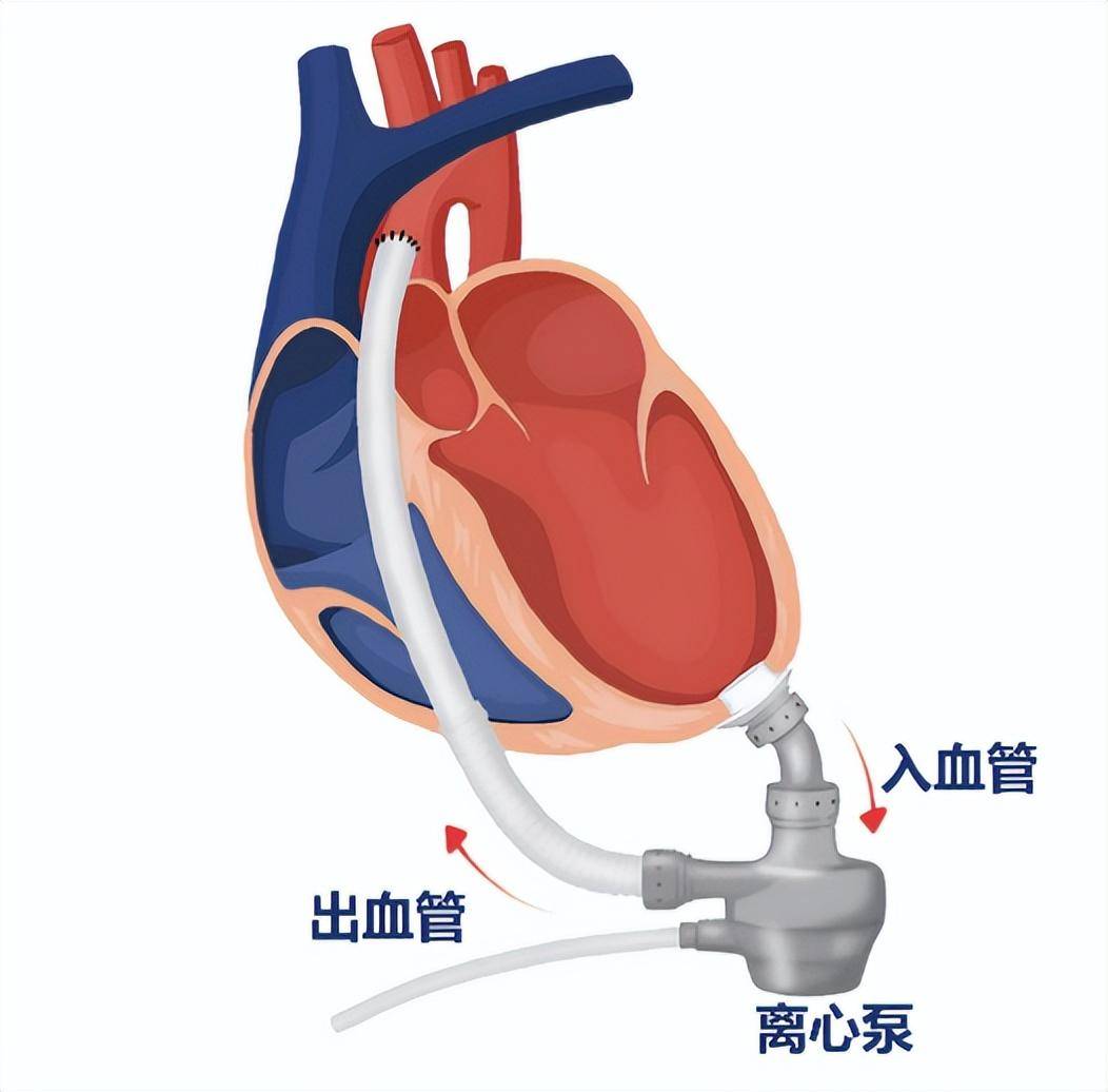 微创evaheart人工心脏手术在闽成功实施_肖先生_患者_治疗