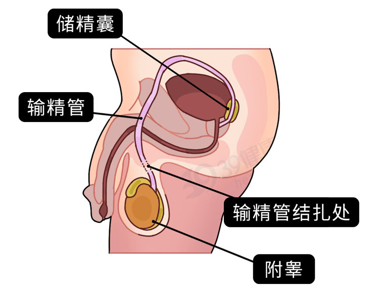 男女性结扎部位图片