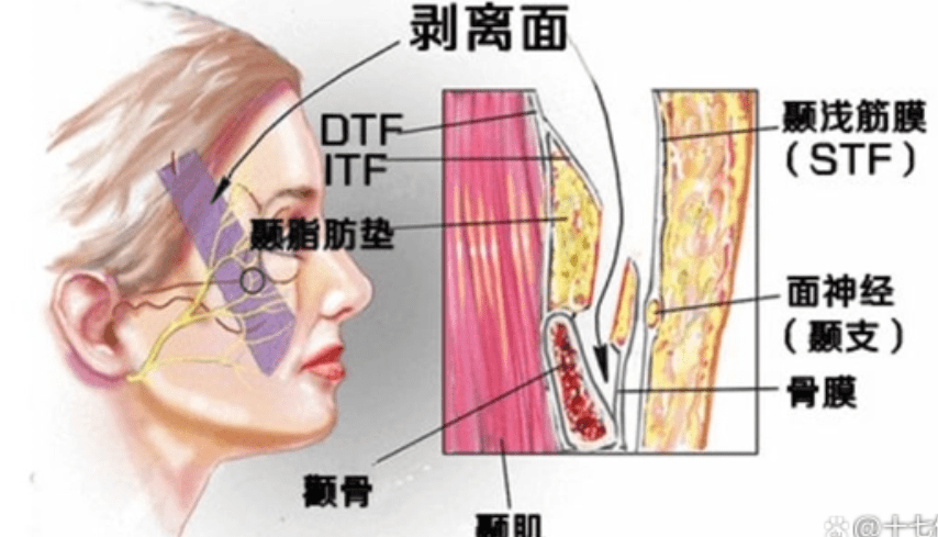 鼓动我青春的脸部筋膜提升多少钱？面部筋膜提升术是什么手术？