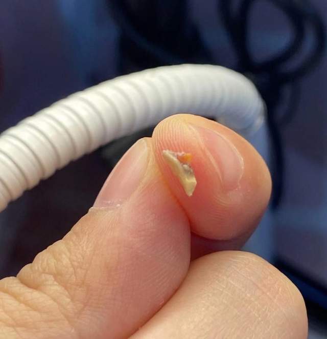 牙结石厚到用手抠?过来人传授你三大秘诀,学会后终身受益!