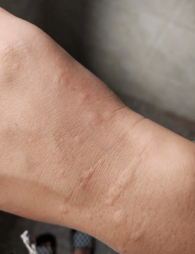 皮肤_调节_胳膊