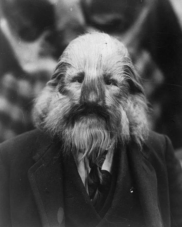 斯蒂芬比布罗斯基,也被称为"狮子脸人莱昂内尔",1890年出生于波兰.