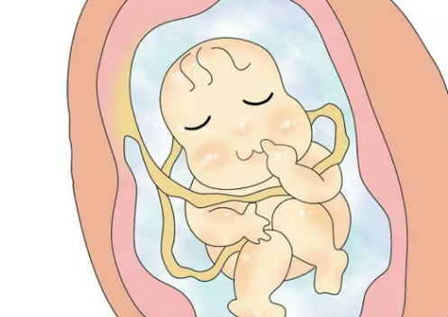 宝宝"脐带绕颈"?