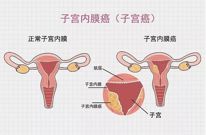 绝经后阴道出血,真的是重回年轻态?