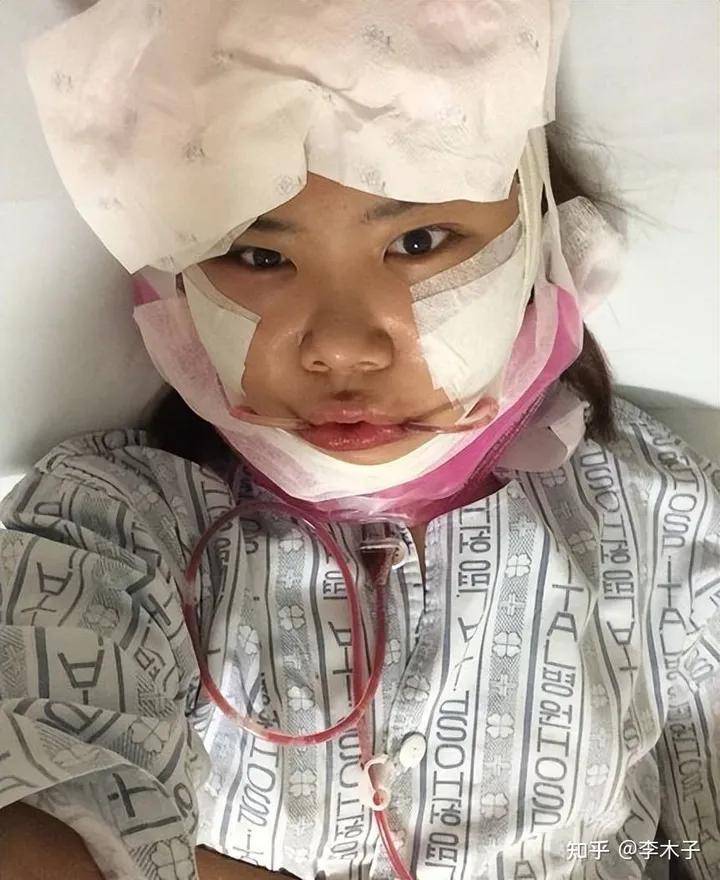 磨骨需要多久恢复期,磨骨恢复过程图一个月,个人亲身经历~_the_营养